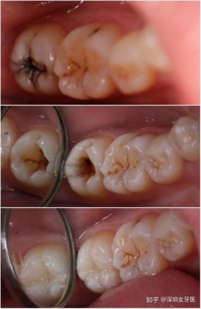 补牙是怎么补的