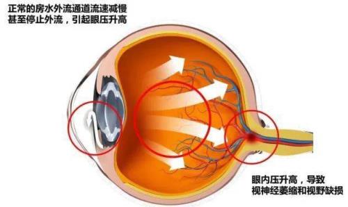 偏光眼是怎么回事