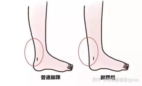 女生跟腱长度标准