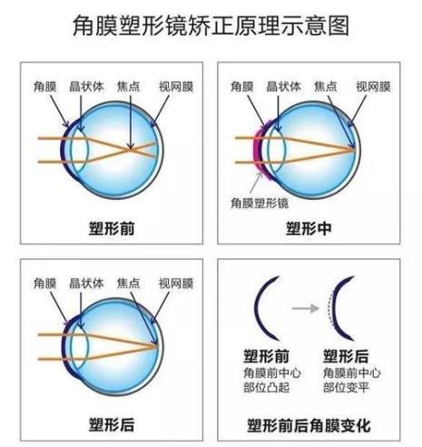 ok镜与隐形眼镜的佩戴方法