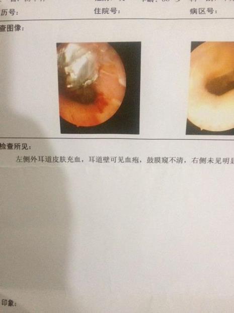 耳朵鼓膜穿孔严重吗