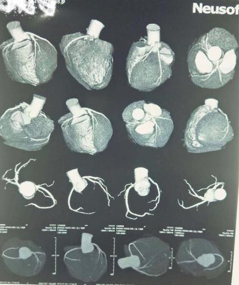 心脏冠脉成像CT有没有危险