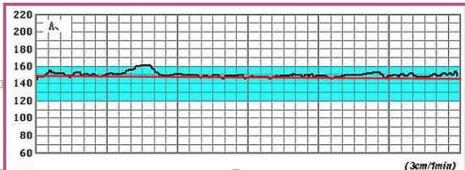 胎心监护缩写
