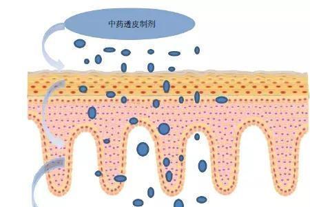 透皮给药制剂研究进展如何