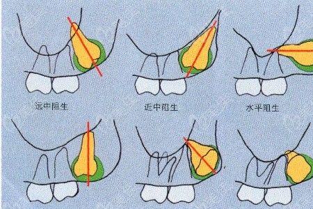 在燕郊拔牙需要多少钱