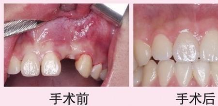 镶牙国家新规定