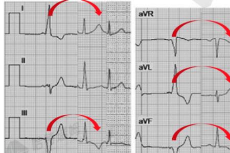 T波倒置是什么意思
