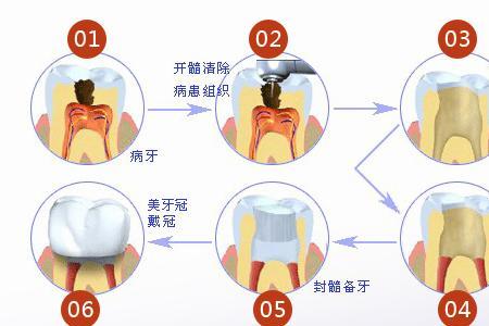 补牙在医保报销范围之内吗