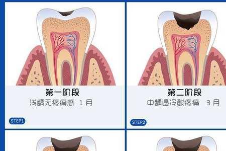 补牙洞多少钱一颗