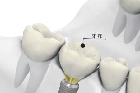 种植牙公费医疗报销吗