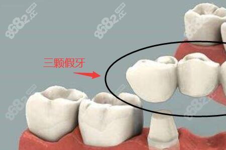 医院镶牙多少钱一颗