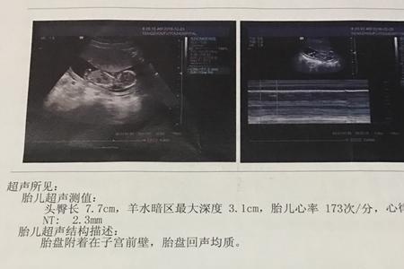 孕13周胎儿稳定了吗