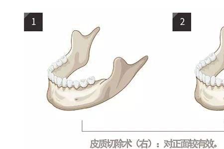 削骨和磨骨的区别