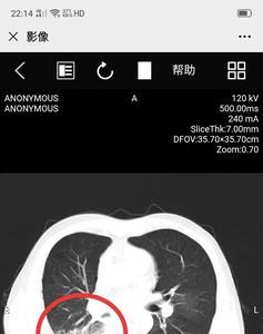 ct片子怎么销毁