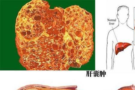 多发性肝囊肿可以考公务员吗