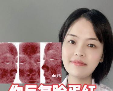 玫瑰痤疮可以用什么定妆粉