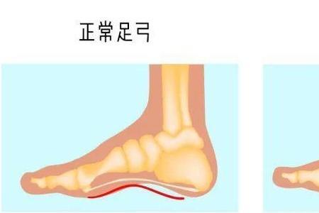 扁平足跑步用足跟还是用前掌