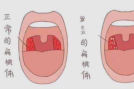 扁桃体发炎了怎么安慰女友