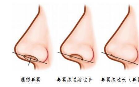 鼻翼小鼻头大是什么鼻型