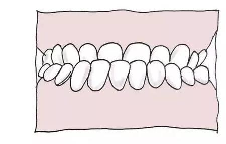 上门牙和下门牙正常距离
