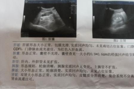 胆囊息肉对公务员录用有影响吗