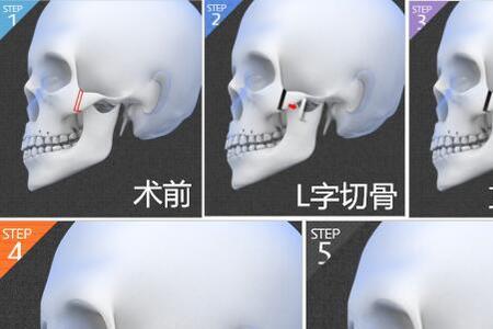 体内有钛夹过安检报警吗