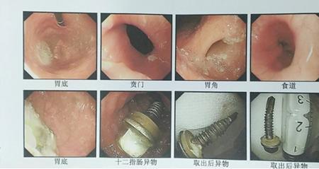 怎么判断小孩有没有误食螺丝钉