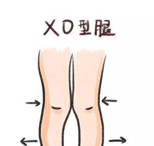 xo型腿有天赋吗