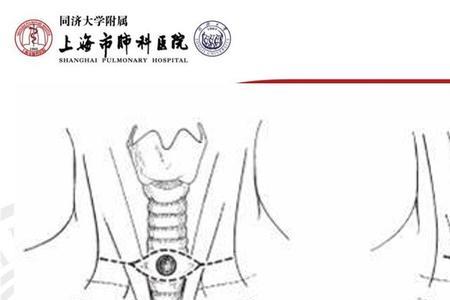 气管切开金属管怎么拔出来