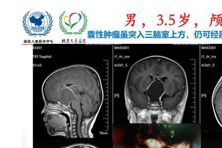 六岁儿童头颅圆周是多少厘米