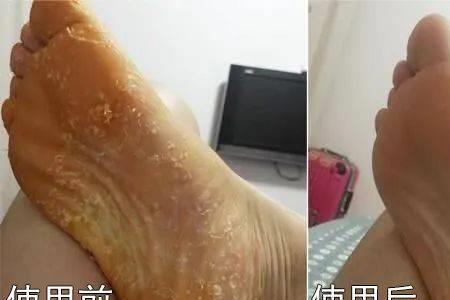 为什么便宜的鞋子容易烂脚丫