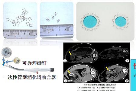 吻合器除了钉子还有什么