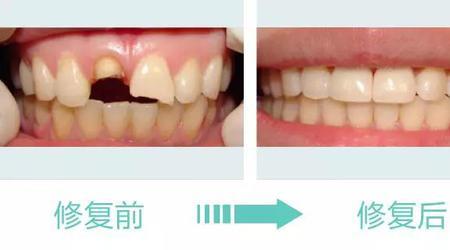 国产陶瓷牙和进口陶瓷牙的区别