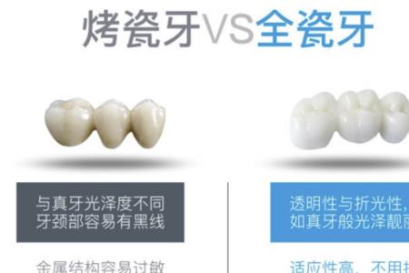 全瓷牙中好的普通的有区别吗