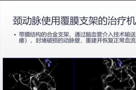 覆膜支架与普通支架区别