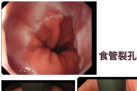 食管裂孔疝  读音