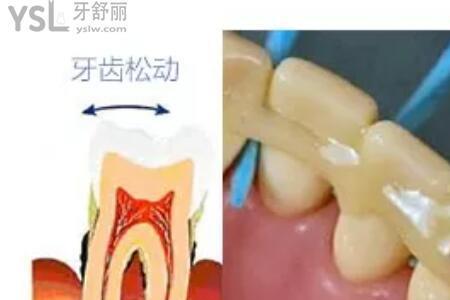 上面的后槽牙怎么清理