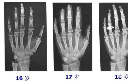 14岁男孩骨龄特征