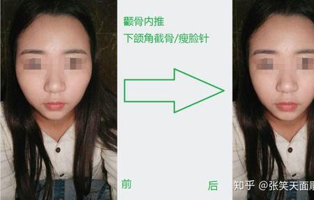 为什么亚洲人颧骨比较宽