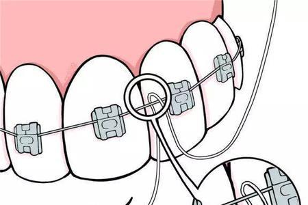 为什么用牙线取不出来