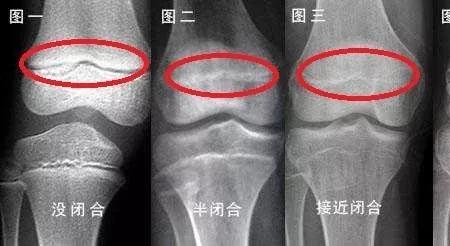 11岁男孩144cm成年有多高