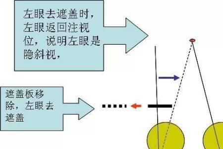 exo远斜跟近斜远代表什么