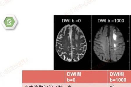 dwi扩散受限如何理解