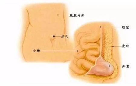 疝气打一成语