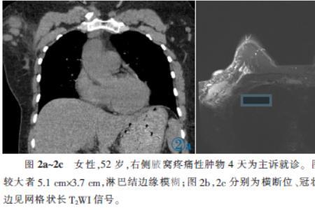 adc医学影像学是什么意思