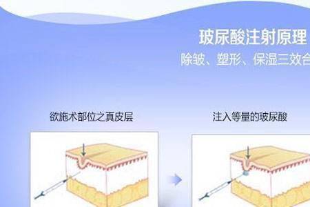 纽拉玻尿酸是大分子还是小分子