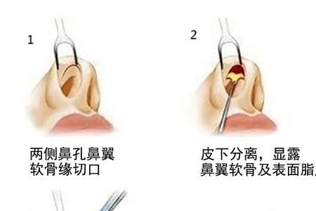 蒜头鼻怎么改善学生党