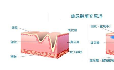 玻璃酸是什么材料