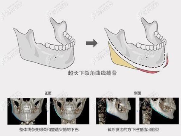 下颌平面角是什么