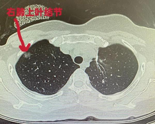 查肺结节在县级医院准确率